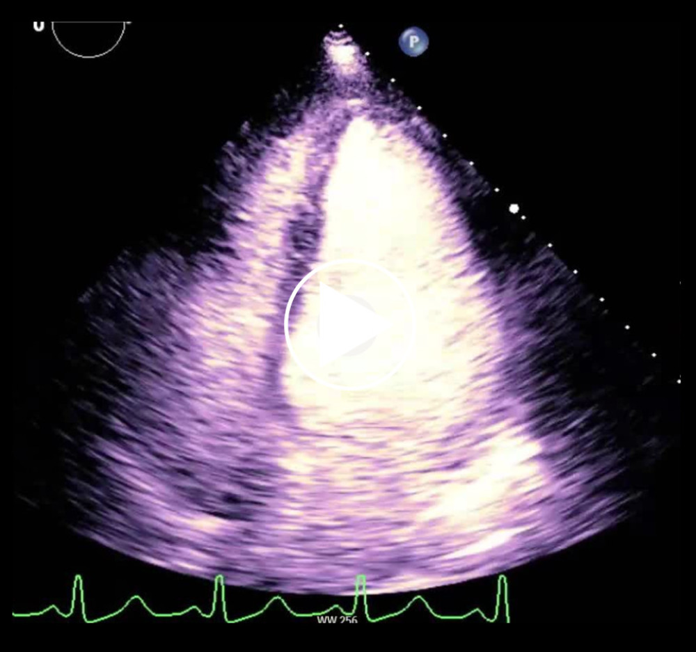 TTE with contrast showing regional wall motion abnormalities.