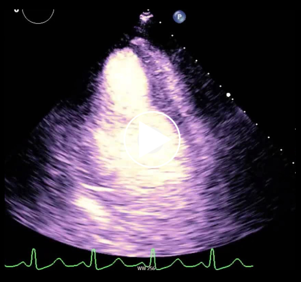 TTE with contrast showing regional wall motion abnormalities.