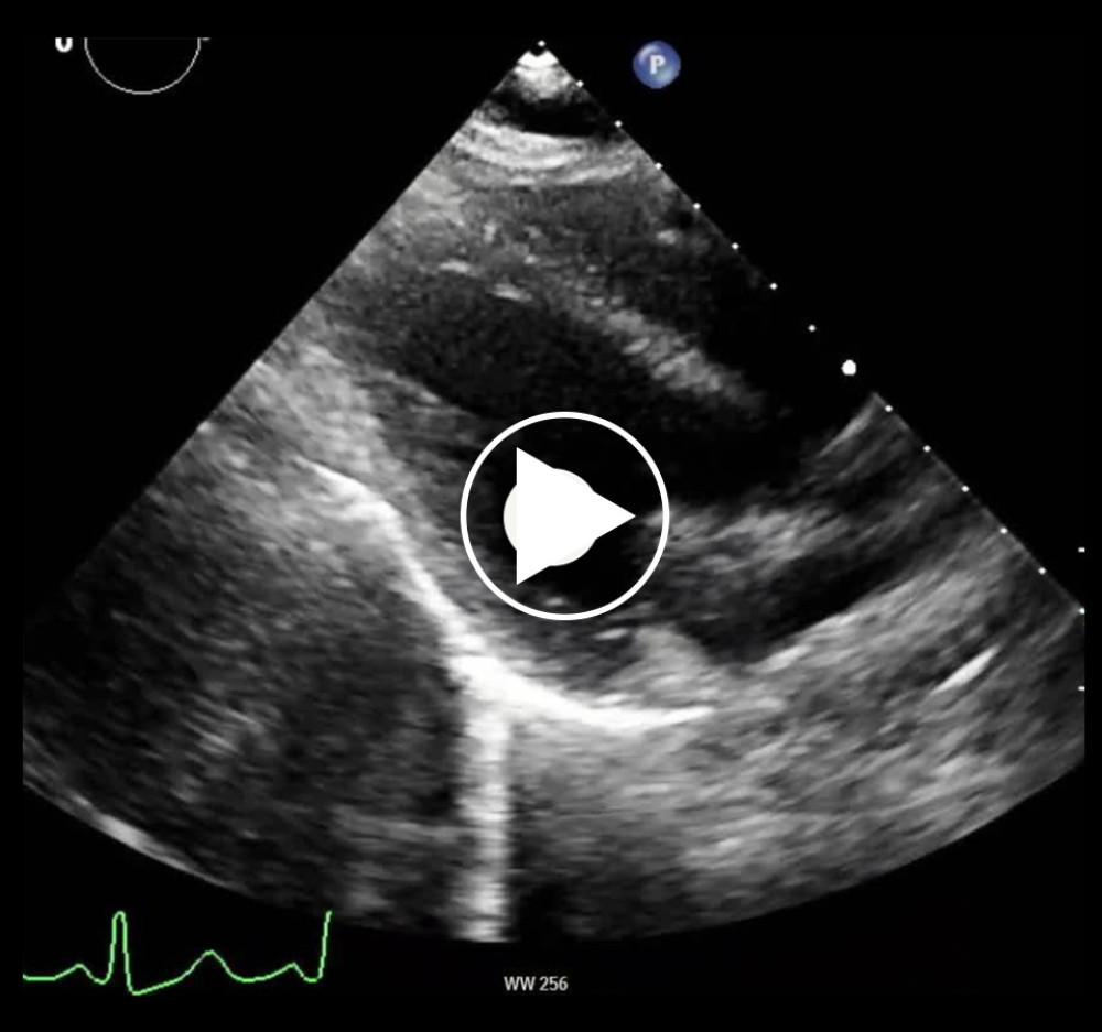 TTE without contrast showing regional wall motion abnormalities.
