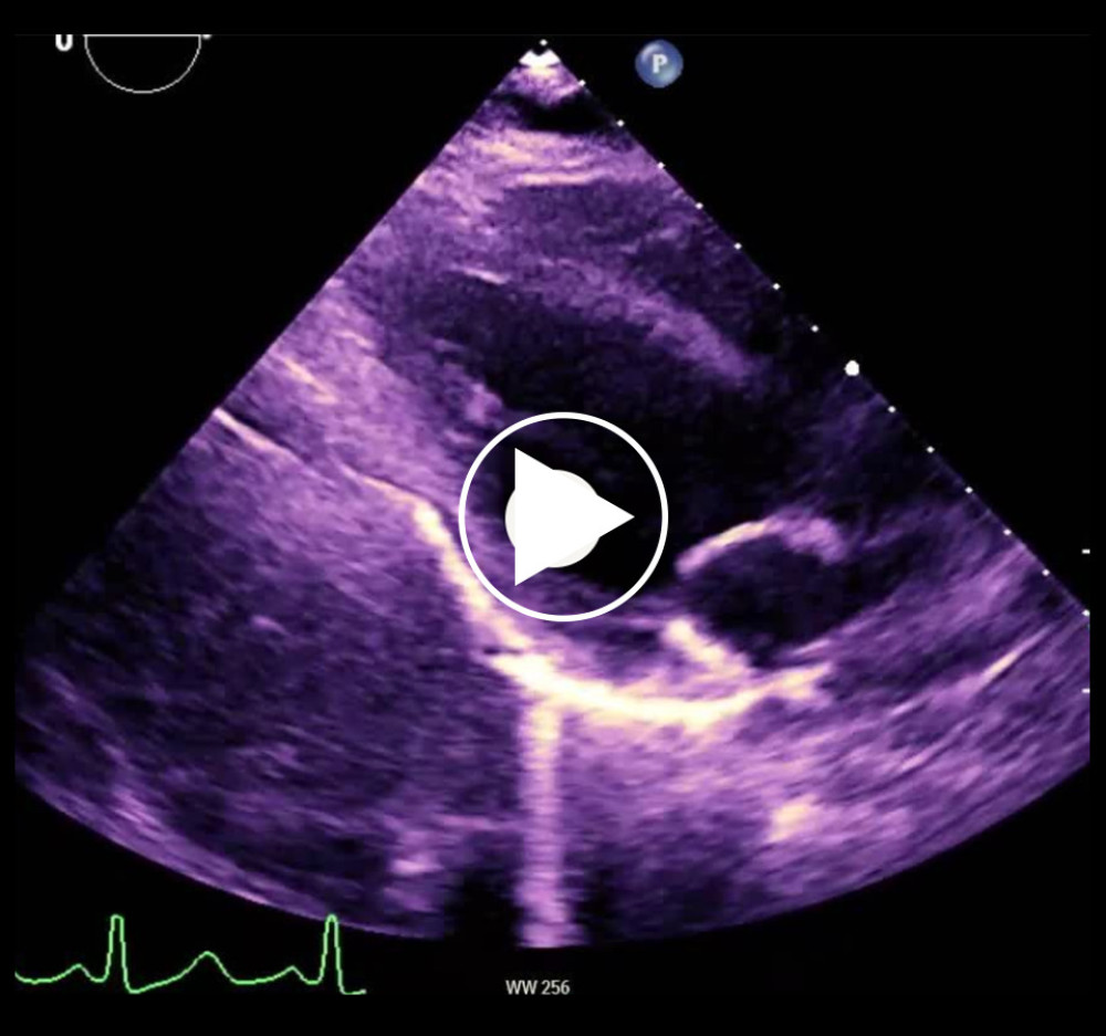 TTE without contrast showing regional wall motion abnormalities.