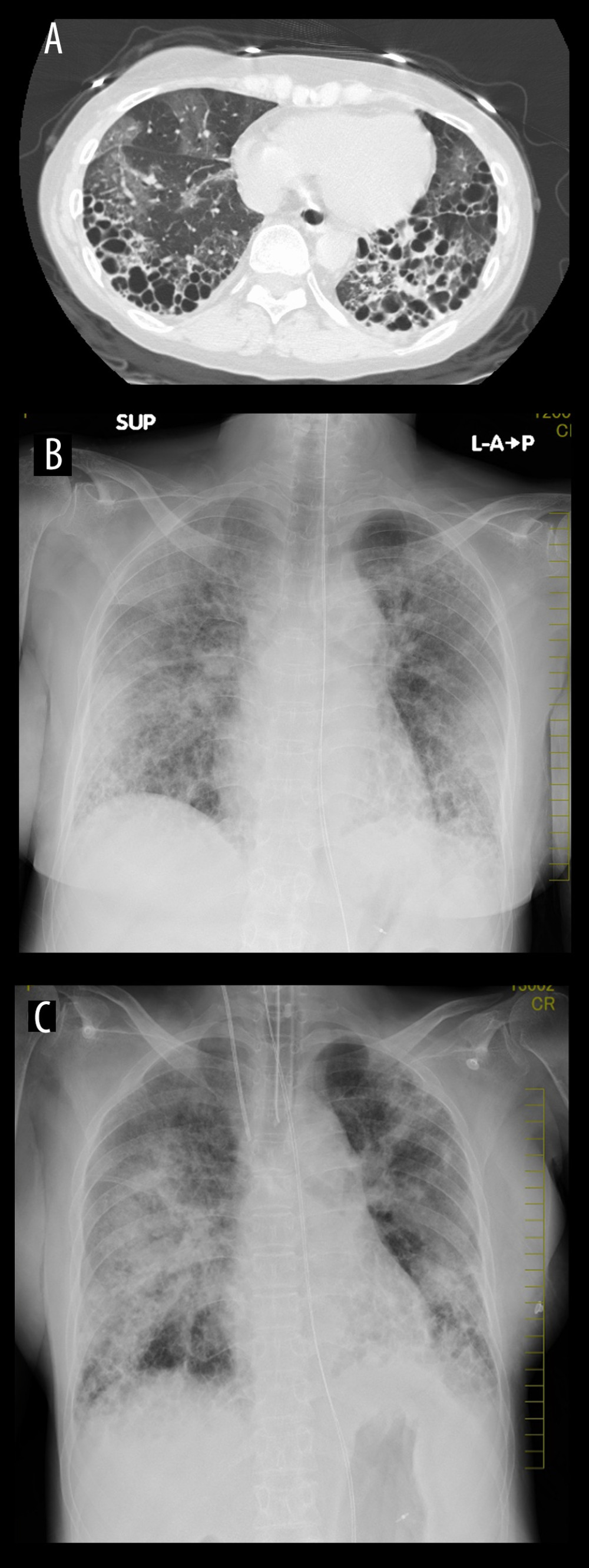 Chest computed tomgraphy (A) and X-ray (B, X-ray on hospital admission; C, X-ray on ICU admission). (A) Non-segmental bilateral ground-glass opacities in the diffuse area and honeycomb associated with interstitial pneumonia in the bilateral dorsal aspects of the inferior lung lobe, (B, C) Two chest X-rays reveal bilateral diffuse grand-glass opacity.