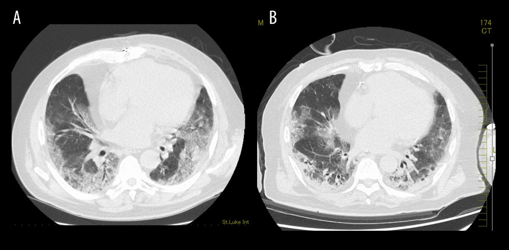 Chest computed tomography scan on admission (A), on S. maltophilia culture (+) (B). (A) bilateral ground-glass opacities and reticulation with subpleural distribution; (B) bilateral consolidation with bronchiectasis and expansion of bilateral ground-glass opacity area.