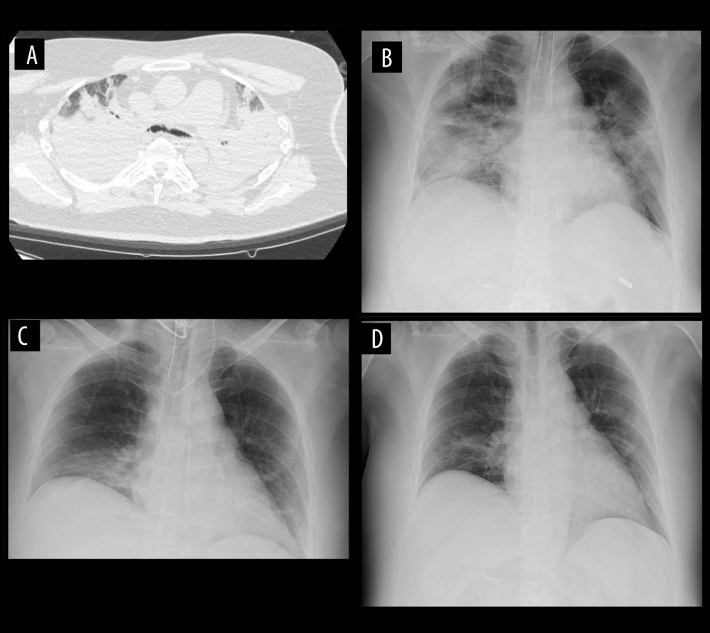 Chest computed tomography scan on admission (A) and X-ray on admission (B), on S. maltophilia (+) (C), and on day 22 of hospital admission (D). (A) bilateral diffuse consolidation; (B) consolidation in the bilateral lung on admission; (C) right lower lung field on S. maltophilia (+); and (D) consolidation improves on day 22 of hospital admission.