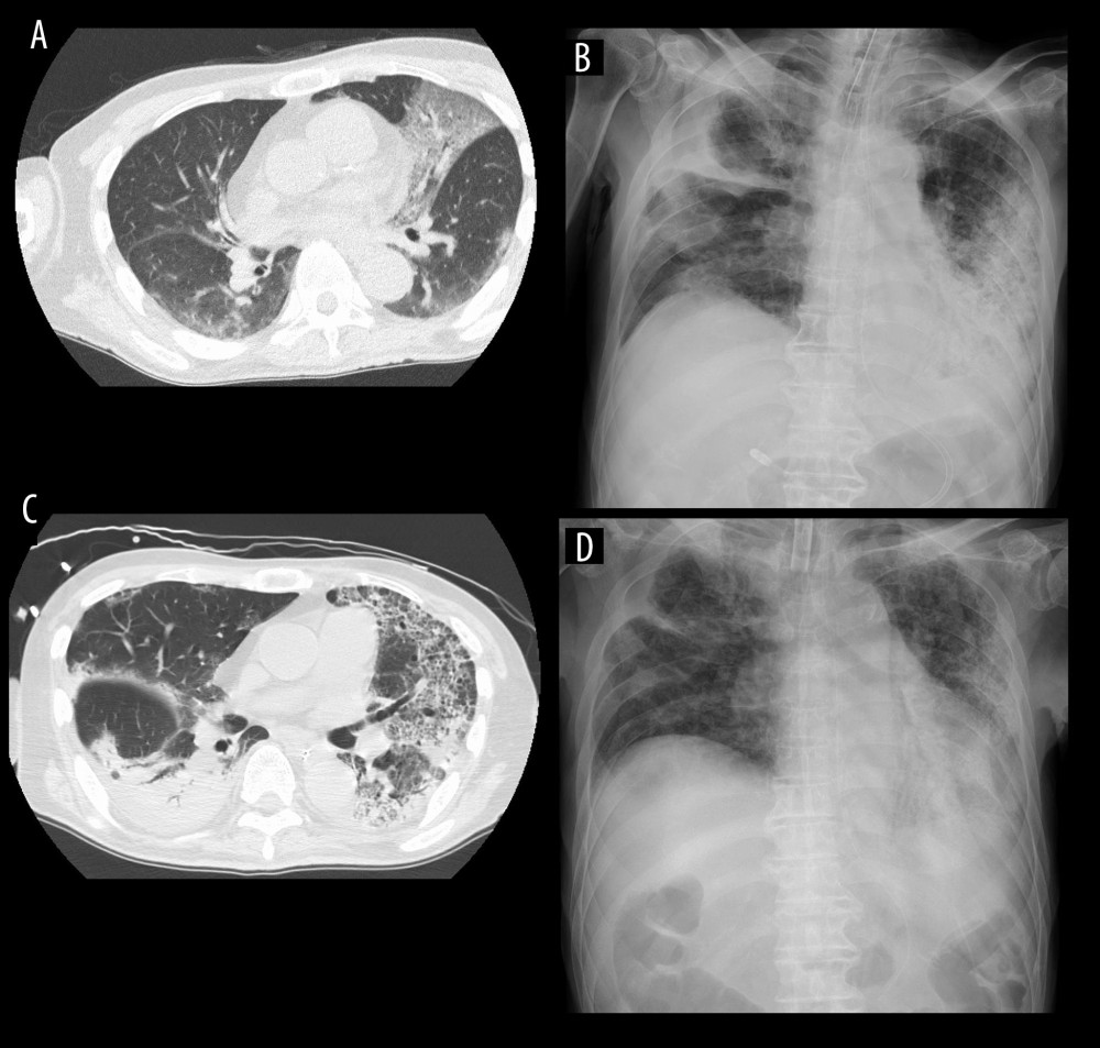 Chest computed tomography (CT) scan and X-ray on admission (A, B) and on maltophilia (+) (C, D). Chest CT and X-ray show ground-glass opacity with subpleural distribution on admission (A, B), non-segmental consolidation with air bronchogram on the right lower lobe, and the progression of bronchiectasis on maltophilia (+) (C, D).