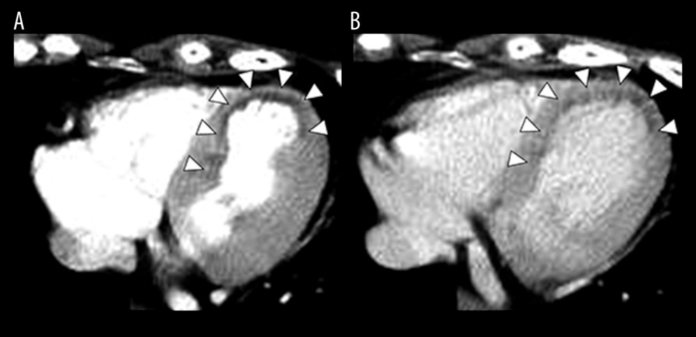 Contrast-enhanced computed tomography from the chest to the pelvis on arrival in the Emergency Department. (A) Early phase (55 s after contrast agent administration), (B) Late phase (110 s after contrast agent administration) showing poor contrast agent uptake by the myocardium on the endocardial surface of the heart (arrowhead) from the septum to the apex.