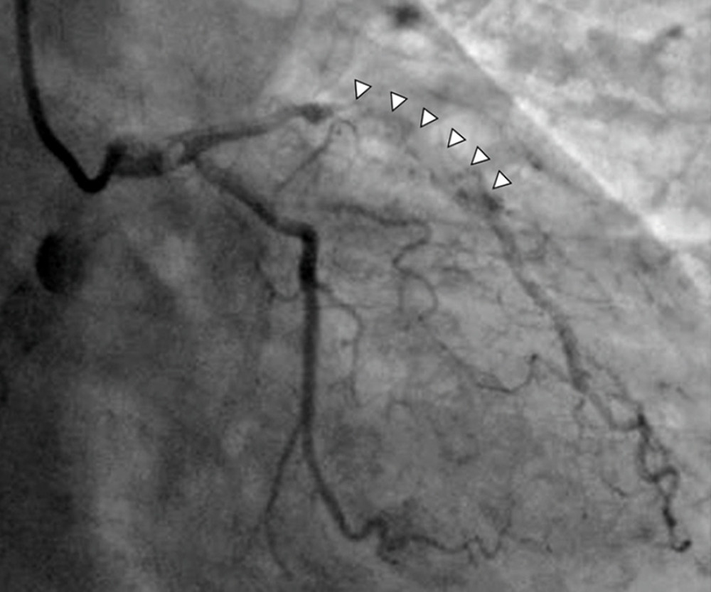 Coronary angiography on the day after symptom onset showing complete obstruction of the left anterior descending coronary artery (arrowhead).