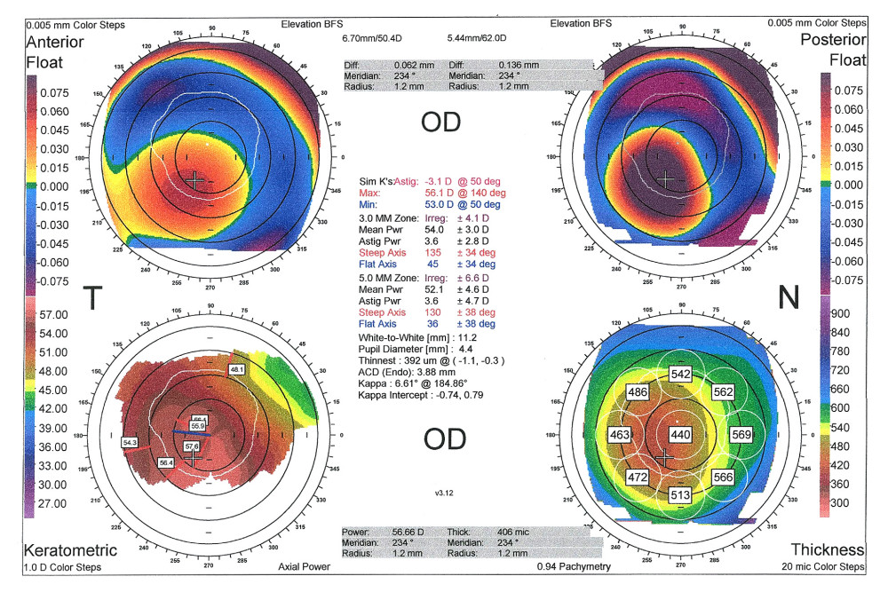 Corneal topography of the right eye showing advanced keratoconus with central thinning and an altered keratometric map in the inferior region.