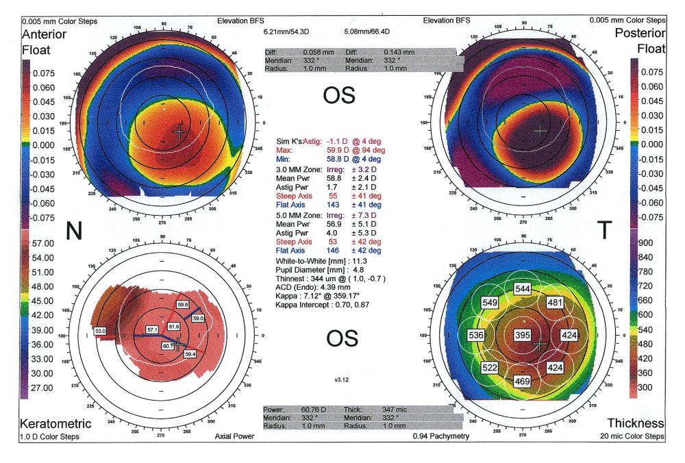 Corneal topography of the left eye displaying advanced keratoconus with central thinning and a generalized highly irregular keratometric map.