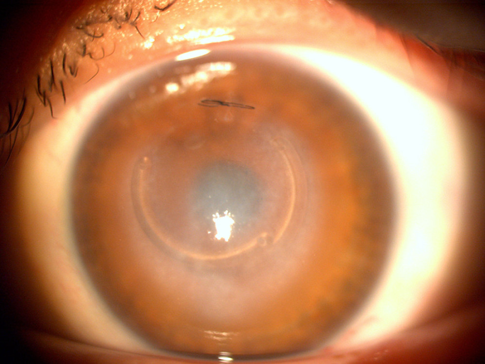 Slit-lamp photograph of the left eye exhibiting severe corneal hydrops and an inferior displacement of both ring segments with the nasal segment sitting above the temporal segment.