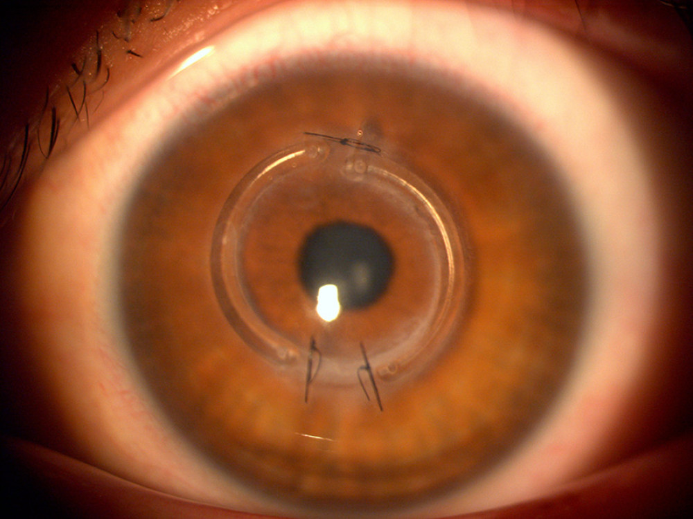 Slit-lamp photograph of the left eye after ICRS reimplantation with a now transparent cornea and 2 new sutures inferiorly affixing the reimplanted ring segments.