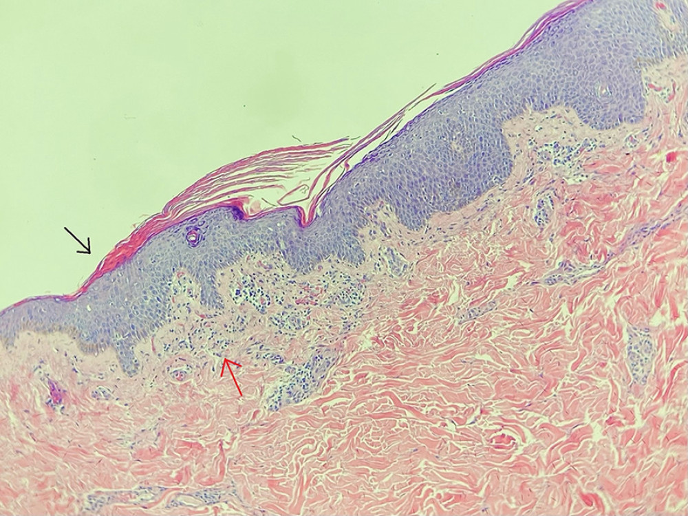 First biopsy. Section of the skin shows an epidermal layer with focal parakeratosis (black arrow), mild spongiosis, and perivascular lymphoid aggregate (red arrow), which are features suggestive of EAC.