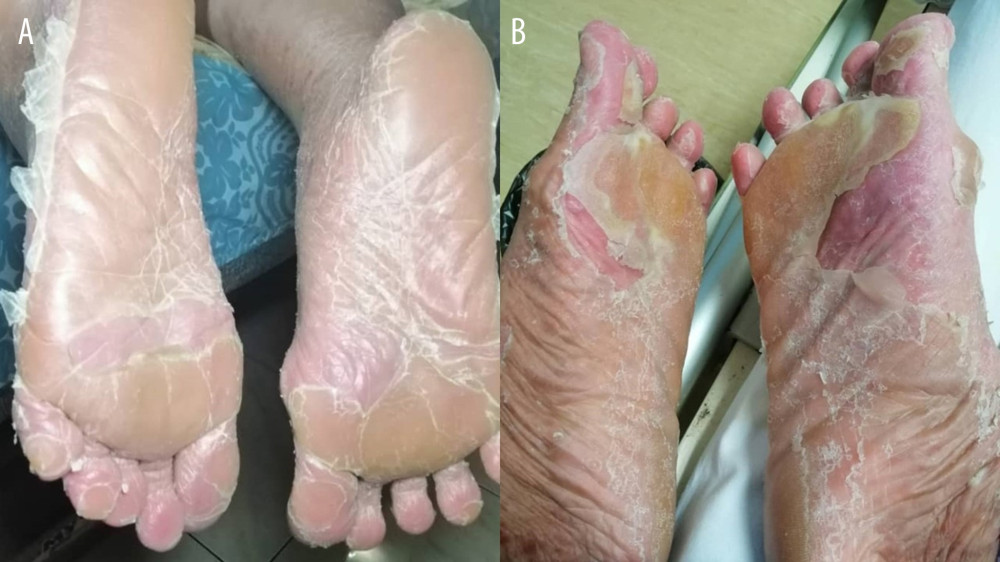 Palmoplantar waxy keratoderma (A) and desquamation (B) on the soles.