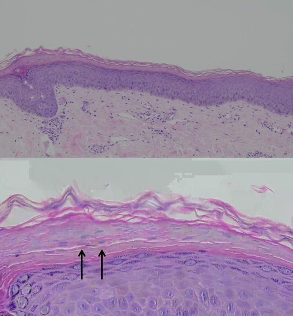 Second biopsy: Acanthosis, spongiosis, focal prominent granular layer, thick suprapapillary plate. The dermis shows perivascular lymphoplasmacytic and occasional eosinophilic infiltration. The stratum corneum shows a vague alternating area of orthokeratoses and parakeratoses (double arrows), which are features consistent with pityriasis rubra pilaris.