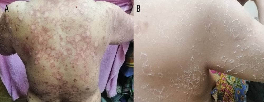 Treatment response. Skin condition after 2 weeks of acitretin therapy (A), and when the patient was entering remission (B).
