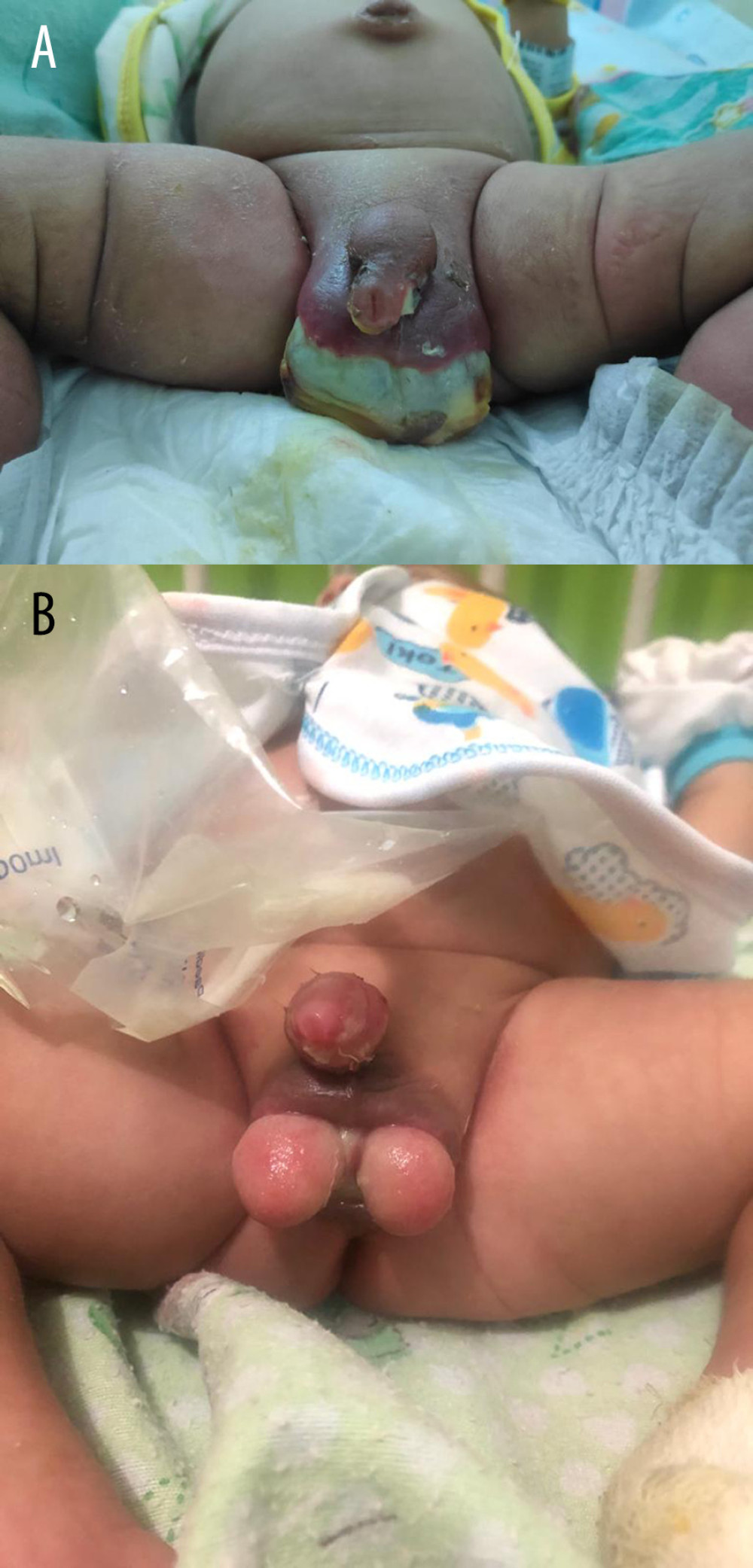 Clinical features of Fournier gangrene and follow-up after surgical management. (A) Appearance on the day of admission. Two-thirds of scrotal skin was covered by white-grayish tissue (slough) and the rest of the scrotum up to the preputium appeared erythematous. (B) Day 5 postoperative debridement; minimal sloughing and no erythema at the testes, scrotal skin, and penis.