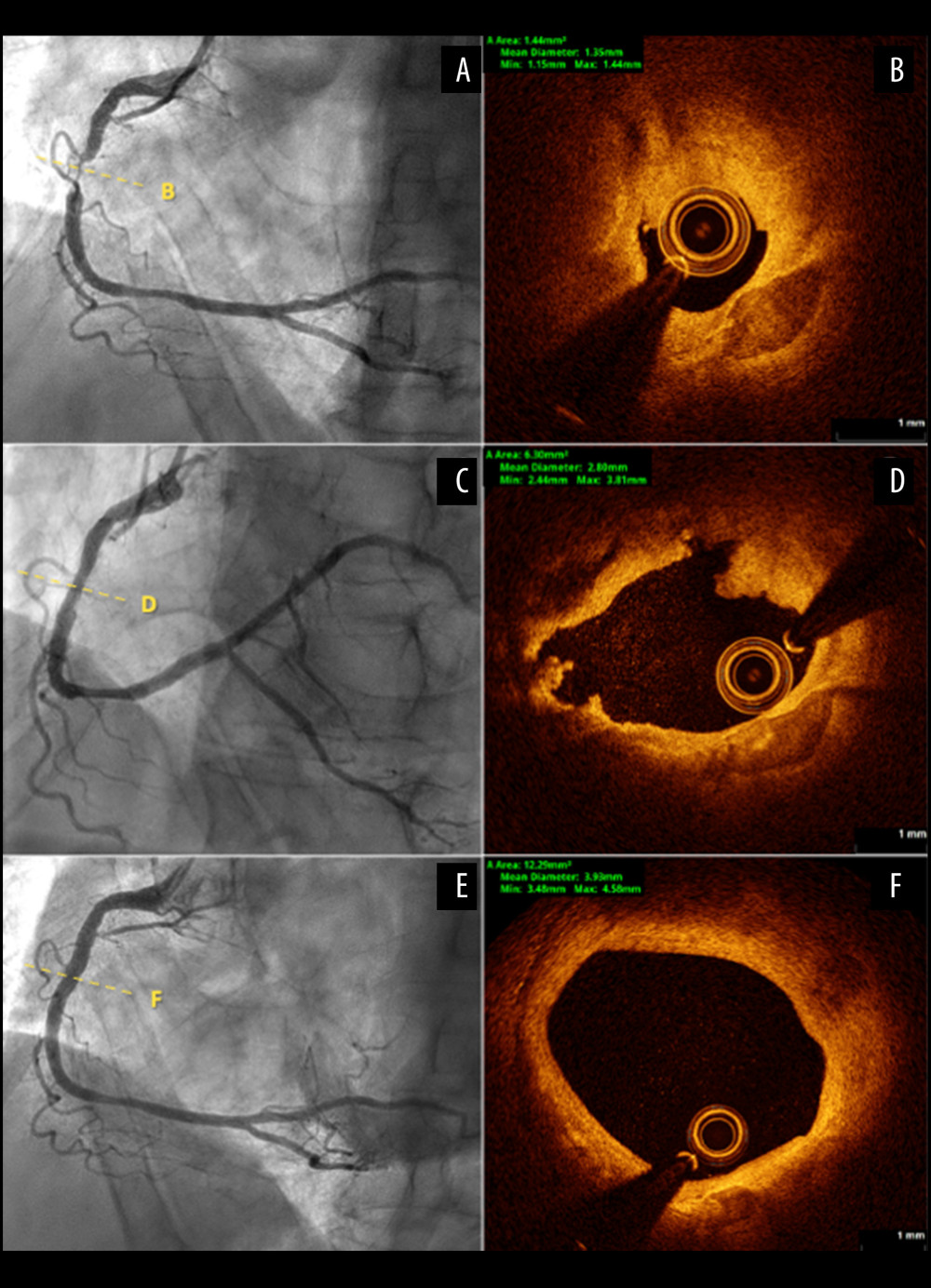 Subtotal stenosis of the RCA; A – Initial angiography with subtotal stenosis of the mid-RCA; B – OCT demonstrated a plaque rupture with presence of thrombus; C, D – Final angiography and OCT showing good luminal gain (6.30 mm2) despite presence of dissections; E – 5 weeks follow-up angiography result, absence of residual dissection and further luminal gain; F – OCT showed rapid resolution of all dissections and further increase of MLA.