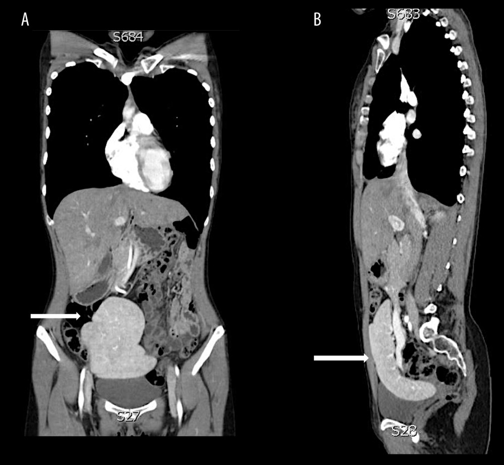 Computed tomography (CT) images of the abdomen with arrows demonstrating a displaced ectopic spleen in the pelvic region characteristic of a wandering splenomegaly. Coronal (A) and sagittal (B) reconstruction planes.