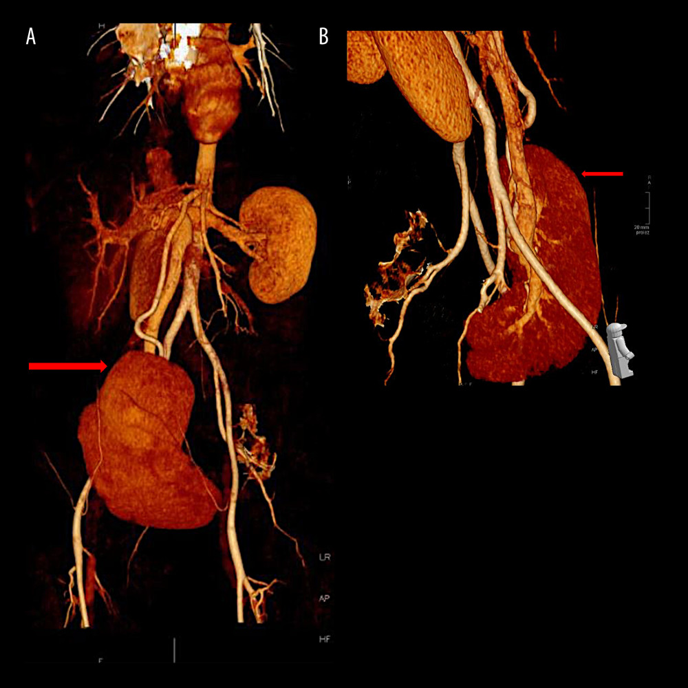 Coronal (A) and sagittal (B) 3D contrast-enhanced CT images with arrows showing the ectopically located spleen in the pelvis. The splenic vein and splenic artery are also seen.