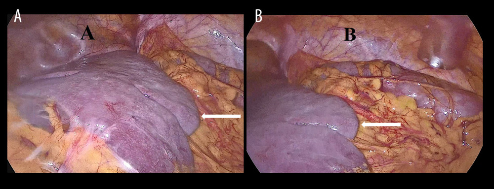 Intraoperative images with arrows of the wandering splenomegaly. Clearly visible are the pelvis (A) and the right parietocolic side (B).