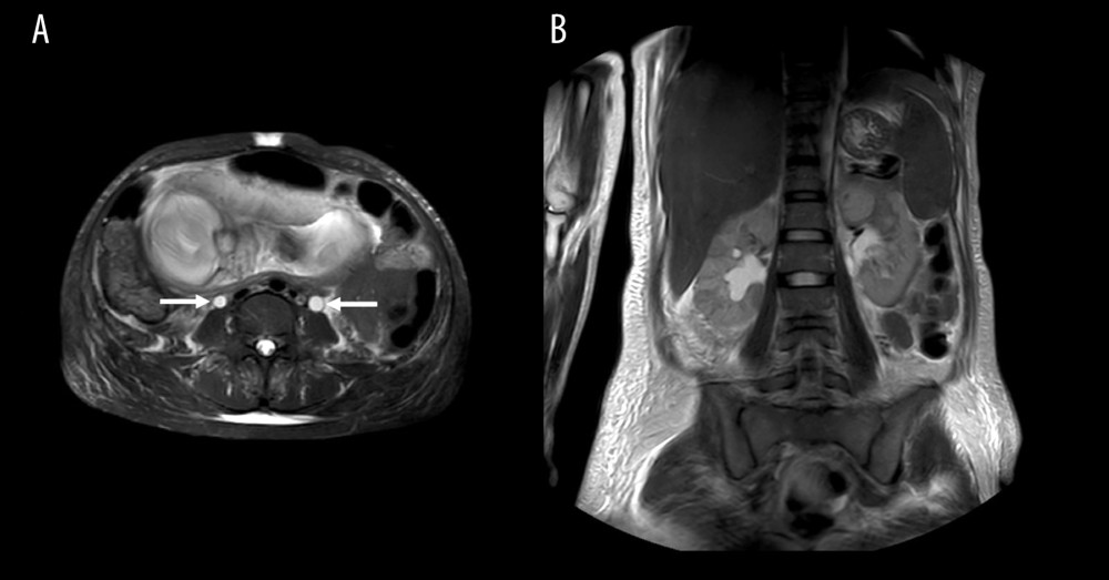 (A) Abdominal MRI showed dilation of the ureters before implantation of double-J ureteral stents (white arrows). (B) Abdominal MRI showed slightly enlarged kidneys, abnormal signals in the kidneys and perirenal cavity, and thickening of renal fascia.