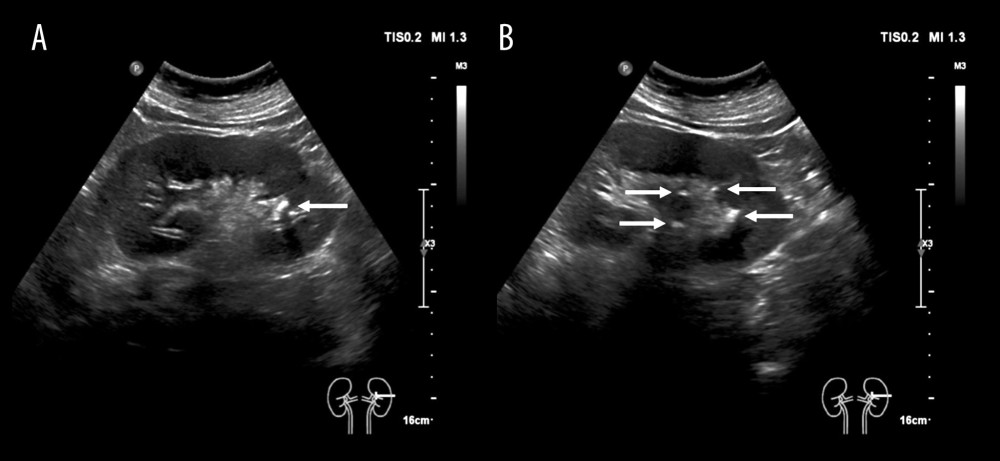 (A, B) Abdominal ultrasound showed stones in the kidneys before implantation of double-J ureteral stents (white arrow).