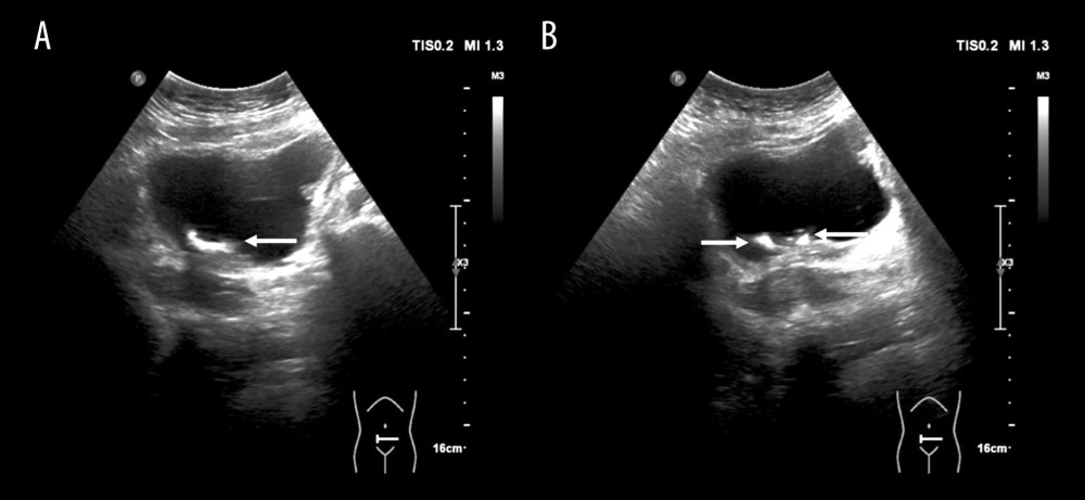 (A, B) Ultrasound showed stones in the bladder after implantation of double-J ureteral stents (white arrows).