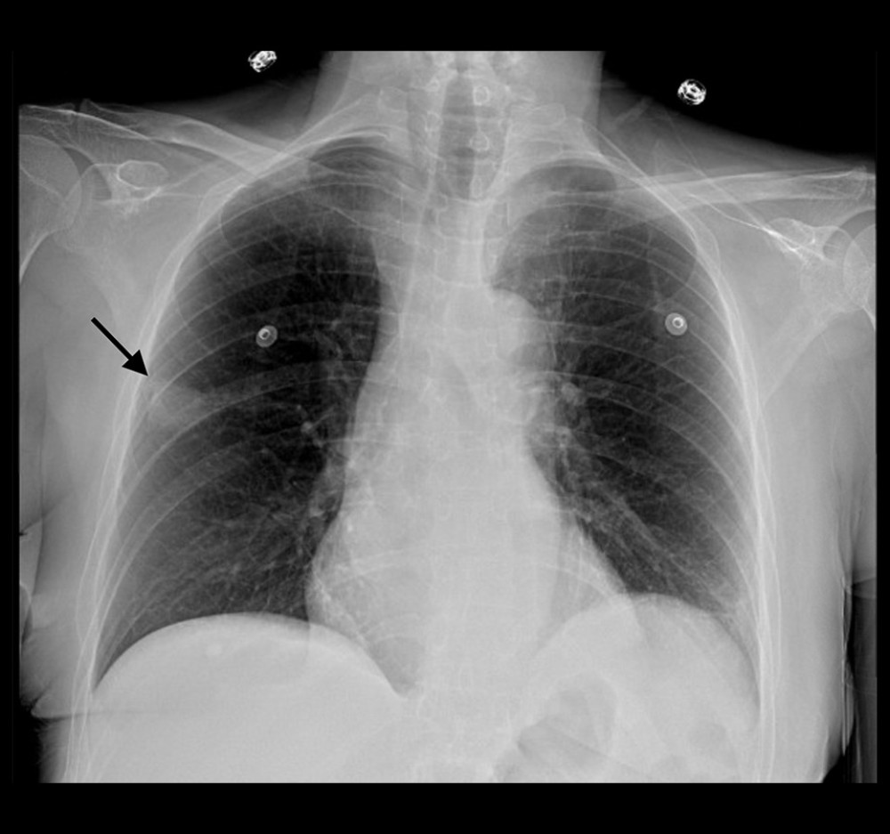 Chest X-ray PA view. XR chest showed slight right greater than left apical pleural thickening. A lobular mass-like density in the right mid-lung measures 1.9×2.8 cm with no focal infiltrate, edema, or effusion.