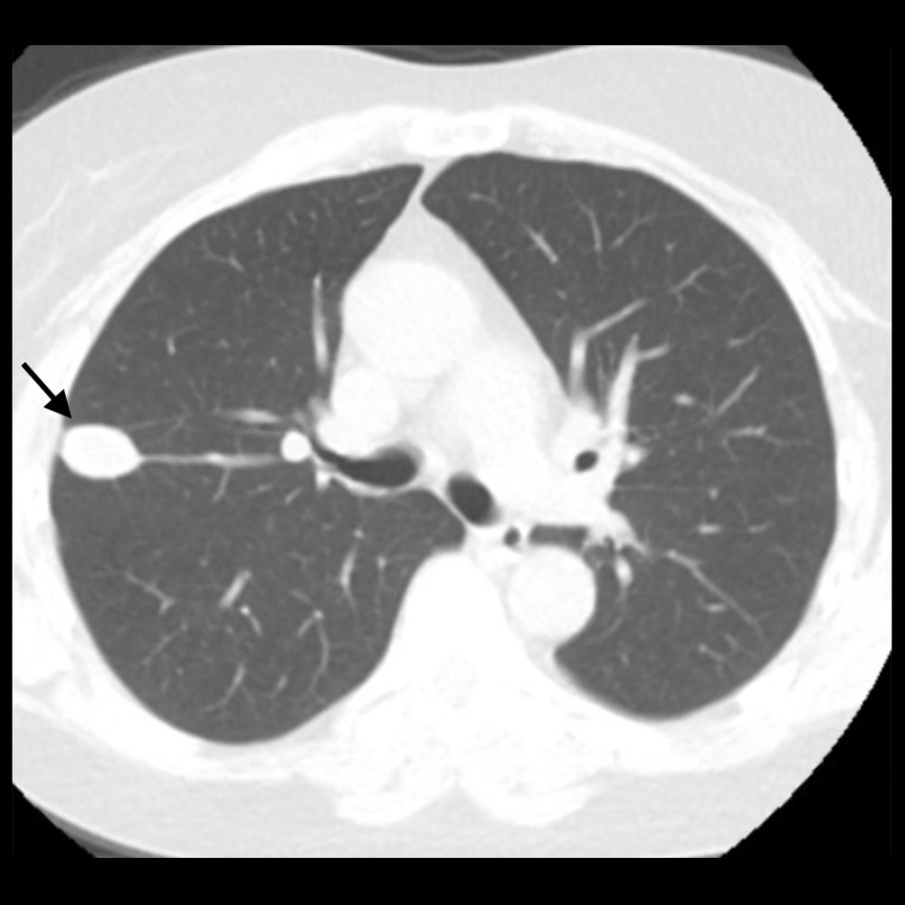 CT scan chest without contrast. CT chest without contrast showing 3.0×1.7 cm airspace opacity at the right upper lobe adjacent to the pleura.
