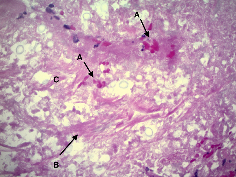 A: Microorganism with a large mucoid capsule of a variable size consistent with Cryptococcus. Positive histochemical stain for mucicarmine and Grocott’s methenamine silver (GMS) stain suggesting Cryptococcus neoformans. (200×). B: Alveolar wall. C: Alveolar space.