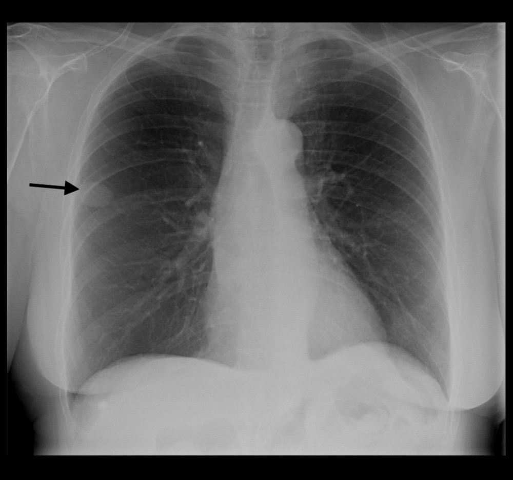 Chest X-ray PA view. XR chest showed an unchanged lobular mass-like density in the right mid-lung measures 1.9×2.8 cm with no focal infiltrate, edema, or effusion.