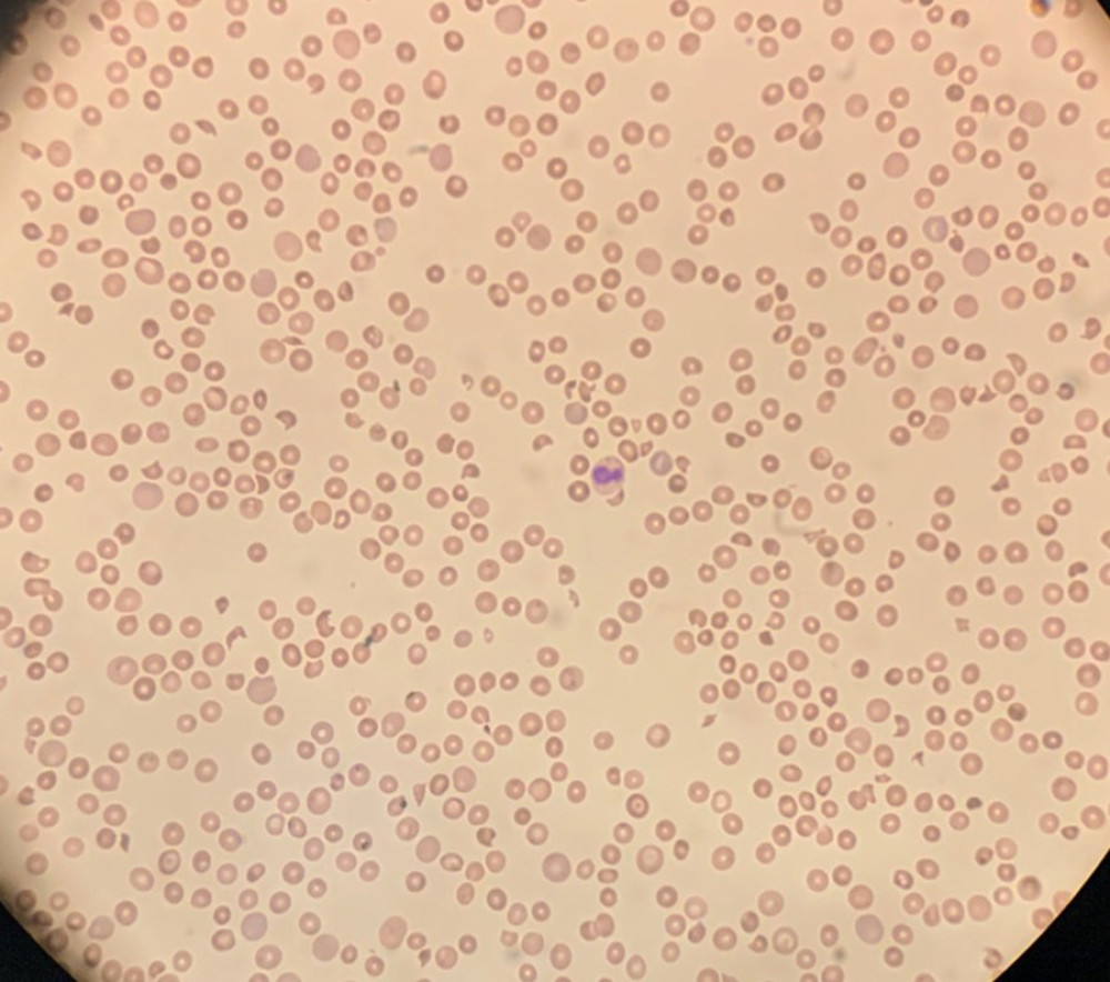 Peripheral blood smear in patient prior to plasma exchange therapy, which revealed numerous acanthocytes, schistocytes, RBC fragments, polychromasia, occasional spherocytes, large platelets, and decreased platelet count, consistent overall with microangiopathic hemolytic anemia.