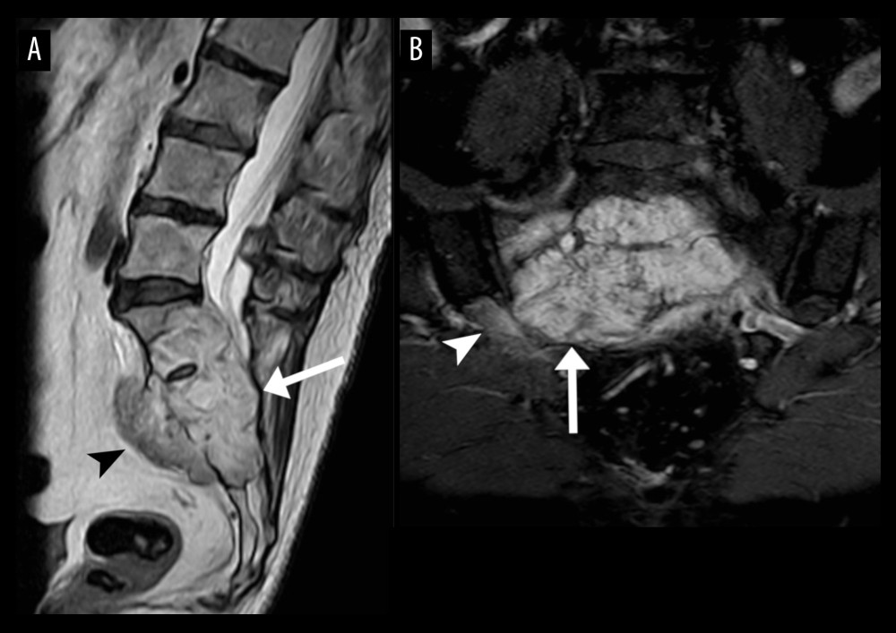 Sacral MRI (2019). The sagittal T2-weighted view (A) reveals a large, lobulated mass (arrow) which is heterogeneously hyperintense and obliterates the sacral spinal canal. The mass has a presacral component (arrowhead). The coronal T1-weighted, post-gadolinium view oriented to the anterior surface of the sacrum (B) reveals that the mass is contrast-enhancing and its presacral extension is more prominent on the right side (arrow). The mass also extends to the iliac side of the right sacroiliac joint (arrowhead).