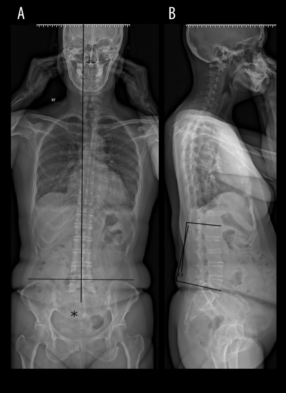 Full-spine radiographs. The anteroposterior view (A) shows an abnormal coronal balance with the patient’s spine deviating to the left of the central sacral vertebral line (the vertical line bisecting the first sacral segment and perpendicular to the iliac crests). The aggressive sacral hemangioma (*) is visible spanning the sacrum, more prominently on the patient’s right side. There is no appreciable scoliotic curvature. The lateral view (B) shows the lumbar lordosis angle (θ) of 7° calculated using a 4-line L1–L5 Cobb method (normal is 20–45°). Thoracic hypokyphosis (flattening) is also evident, while the patient’s C7 plumb line intersected the sacrum, indicating a neutral sagittal balance (measurements not shown). Mild spondylosis is apparent in the lower thoracic and lumbar spine.