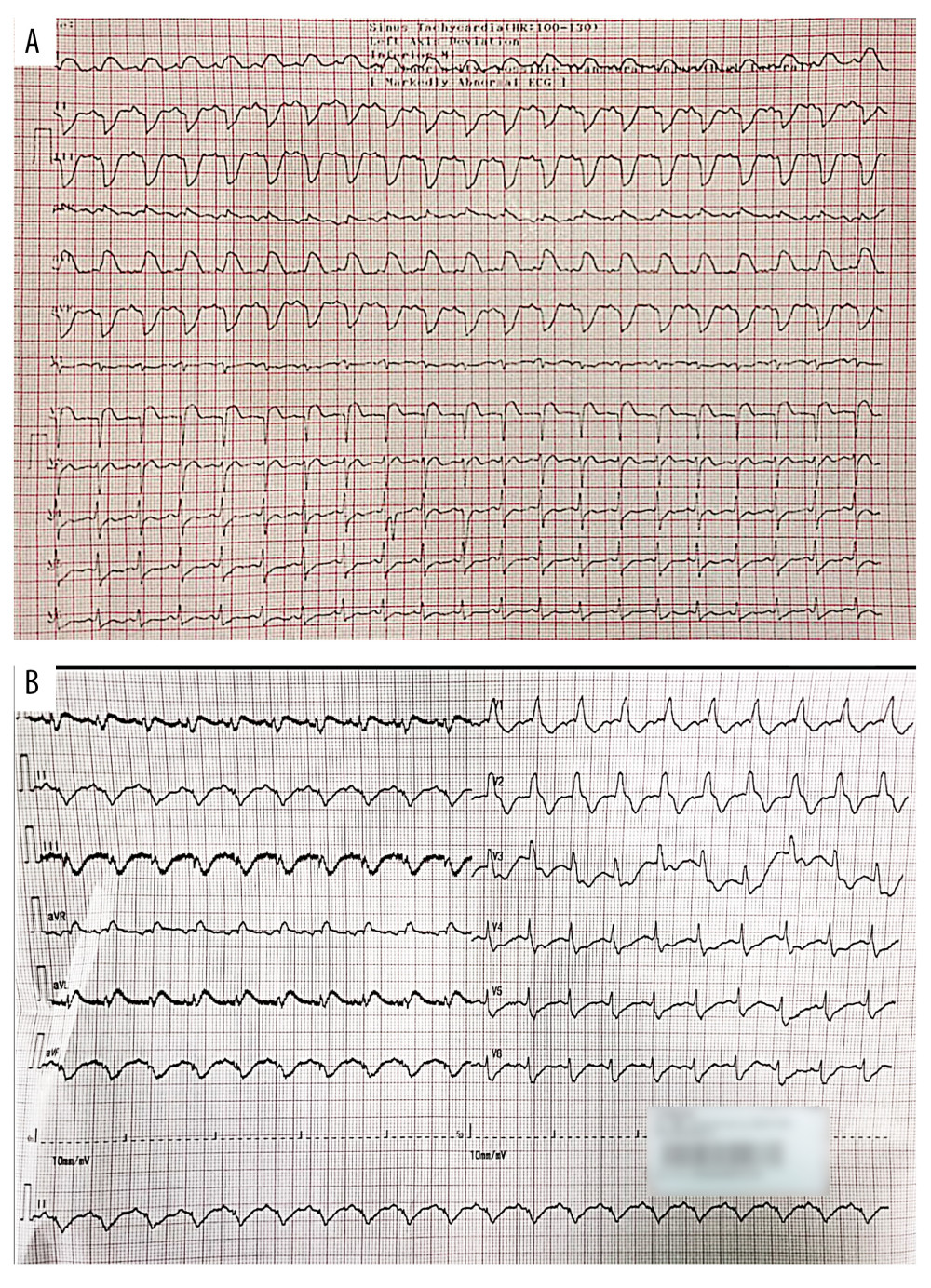 (A) Electrocardiography pre-thrombolytic showed ST-elevation in leads I and aVL with reciprocal ST depression in leads II, III, and aVF. (B) Post-thrombolytic ECG showed ST-elevation in leads I and aVL with right bundle branch block pattern.