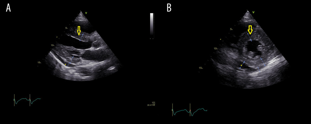 Transthoracic echocardiogram parasternal long axis view at admission showed thickened interventricular septum (arrow) and pericardial effusion at posterior (asterisk) (A). Short axis view showed thickened interventricular septum (arrow) and pericardial effusion at inferior and posterior (asterisk) (B).