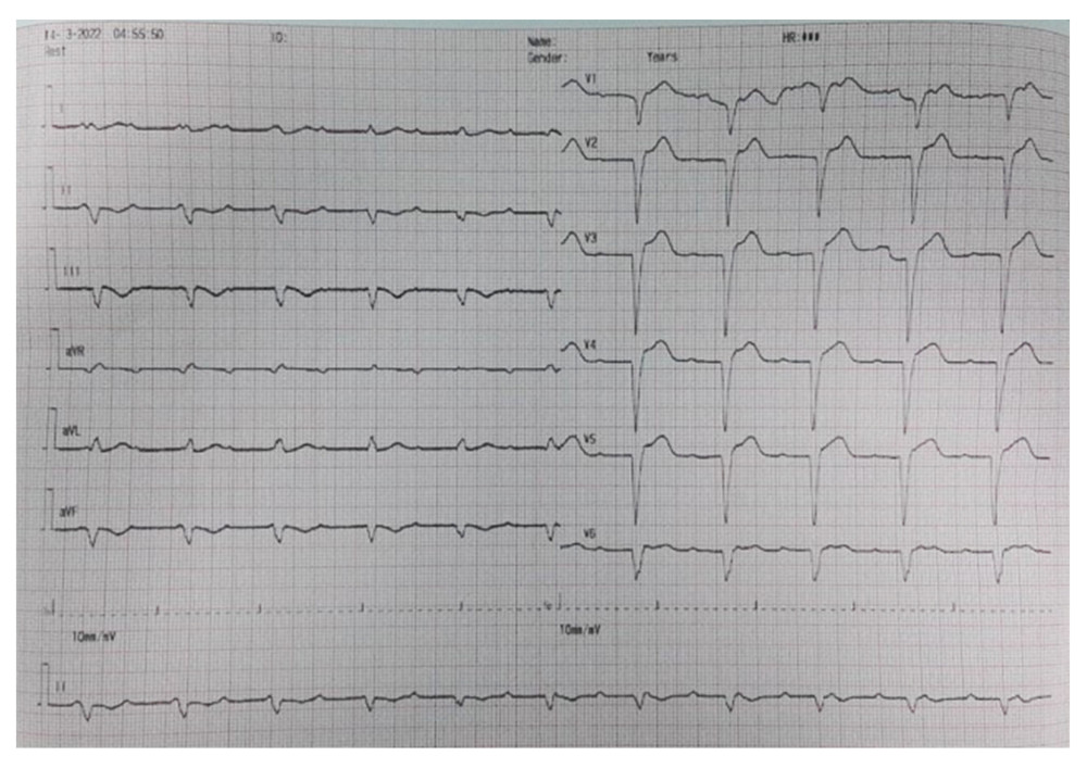Electrocardiography on the second day showed total atrioventricular block with a ventricular escape rhythm of 66 beats per minute and a resolution of ST-segment elevation.