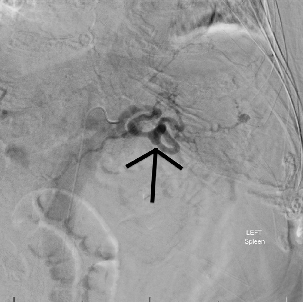 Angiogram showing short gastric artery aneurysm (black arrow).