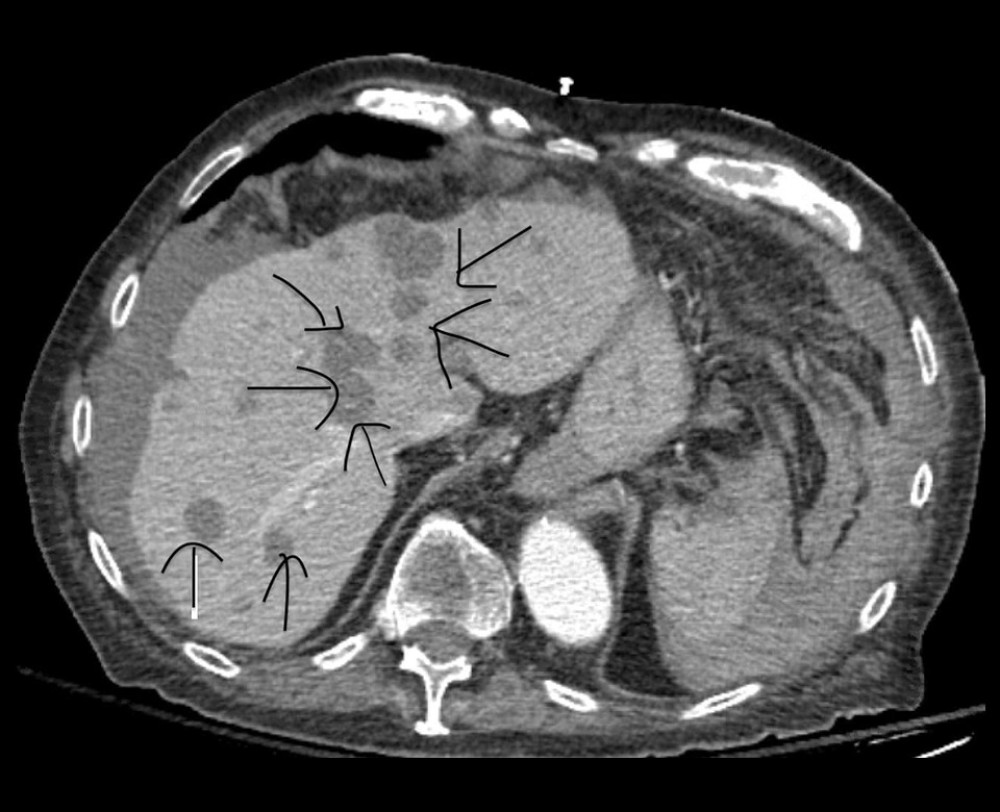 Axial view of a contrast-enhanced portal venous phase CT scan showing liver metastases.