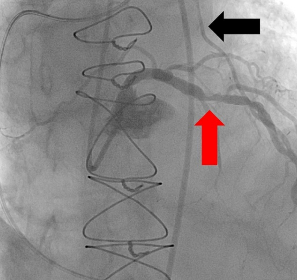 Right anterior oblique cranial view angiogram demonstrating high degree stenosis of the mid left anterior descending artery (red arrow) and reversal of flow through the left anterior descending artery and left internal mammary artery bypass graft (black arrow).