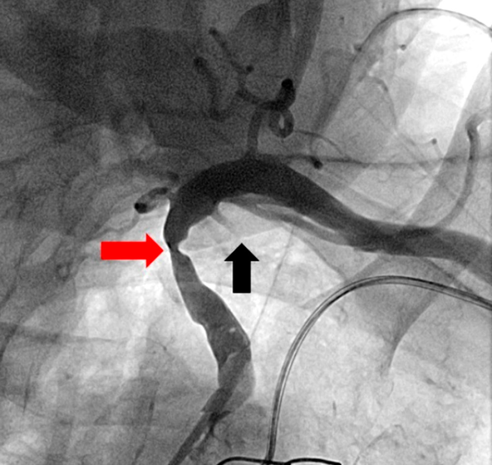 Right anterior oblique angiogram of the patient’s left subclavian artery demonstrating high-grade stenosis proximal to the patient’s left internal mammary artery (LIMA) bypass graft (red arrow). There is competitive flow within the LIMA, indicating flow reversal (black arrow).