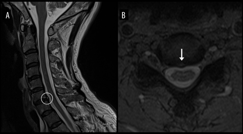 Cervical spine MRI. The T2-weighted mid-sagittal view (A) reveals a small cervical disc displacement at C6–7, with an annular fissure evident as a small area of high T2 signal within the outer intervertebral disc. The T2-weighted axial view at C6–7 (B) reveals a central disc protrusion of 2 millimeters in anteroposterior dimension and shows the annular fissure (arrow). There is no central canal or neuroforaminal stenosis at this level or other cervical levels (not shown).