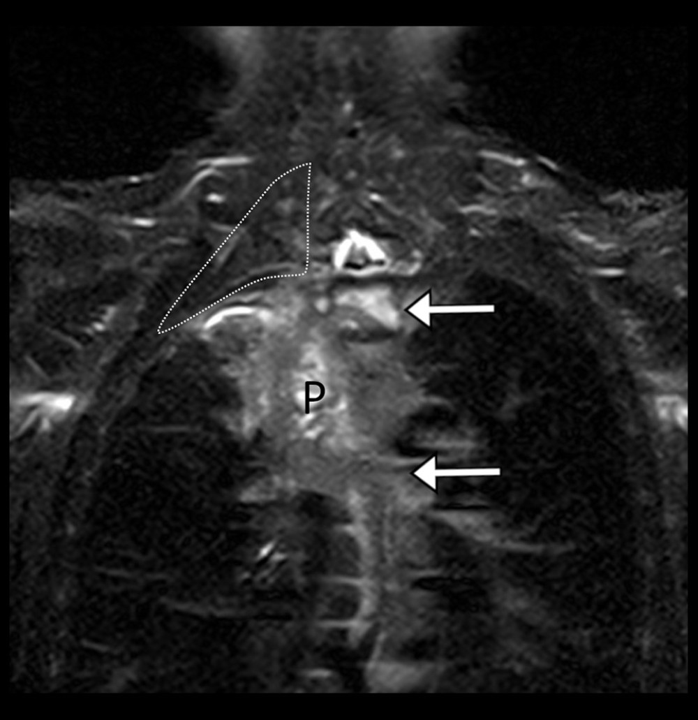 Thoracic spine short tau inversion recovery (STIR) MRI, coronal view. The Pancoast tumor (P) is visible as an abnormal, hyperintense mass in the medial right lung apex, superior mediastinum, and superior sulcus with associated vertebral infiltration which is visible from the spinal levels T2 (upper arrow) through T6 (lower arrow). Although the mass approximates the brachial plexus, which is faintly visible in the area within the dotted line, the extent of plexus involvement is difficult to evaluate as it is not well delineated in this thoracic MRI series. The mass measures 7.5 centimeters in the transverse plane (measurement not shown).