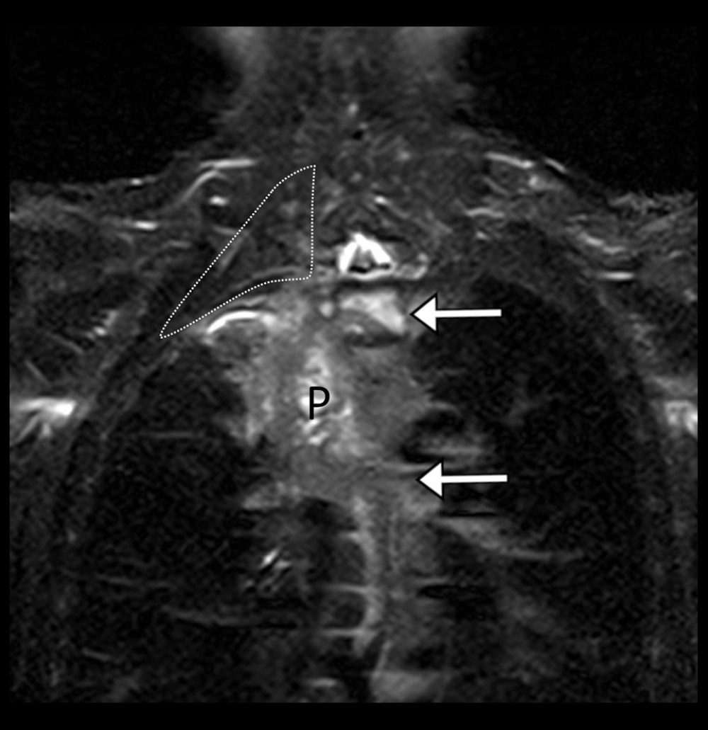 pancoast tumor neck