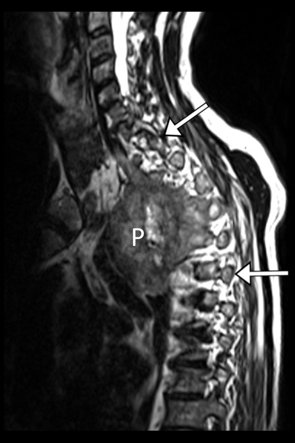 Thoracic spine T2-weighted MRI, right parasagittal view. The Pancoast tumor (P) is evident as a paraspinal mass anterior to and invading the upper-to-midthoracic spine. An abnormal hyperintense signal is seen in the thoracic vertebrae and/or ribs from T1 (upper arrow) through T6 (lower arrow), suggestive of tumor infiltration. The craniocaudal dimension of the mass is 8.7 centimeters (measurement not shown).