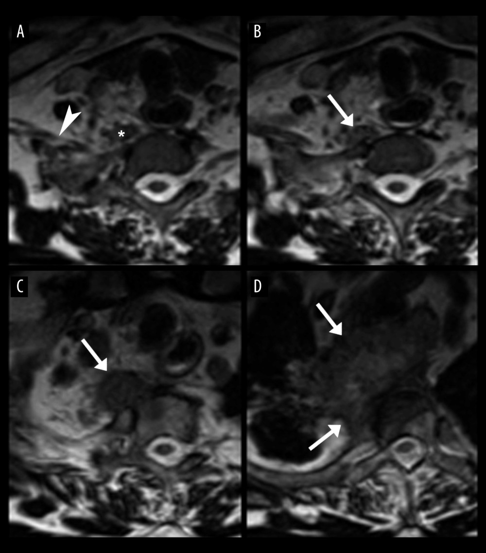 Upper thoracic axial T2-weighted MRI sections. An axial at the level of the first thoracic vertebra (A) shows part of the right brachial plexus (arrowhead) and a segment of swollen prevertebral muscle (*) just cranial to and likely related to the most superior aspect of the Pancoast tumor. The remainder of the brachial plexus is not well visualized due to being out of the field of view. Axials at the second thoracic (B), third thoracic (C), and fourth thoracic (D) show the Pancoast tumor as it becomes larger caudally (arrows).