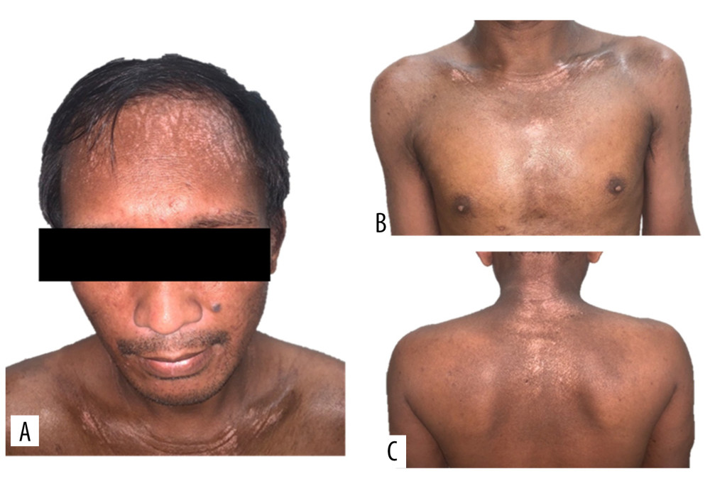 Salt-and-pepper discoloration of the forehead (A), chest (B), and back (C).
