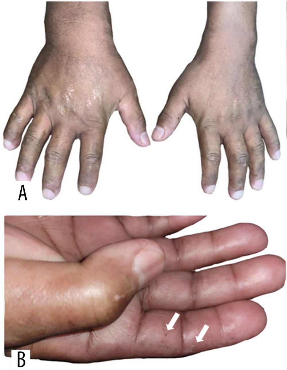 (A) Sclerodactyly. (B) Digital pitting (white arrows).