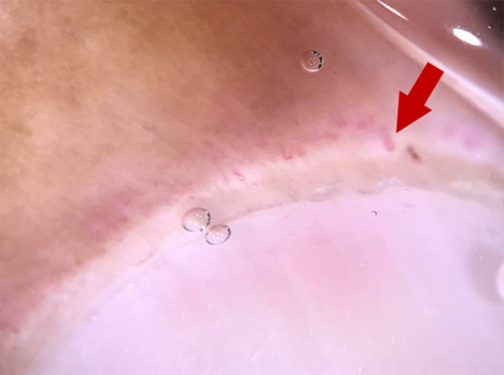 Nail fold capillaroscopy. Few giant capillaries (red arrow) and regular distribution of capillary loops.