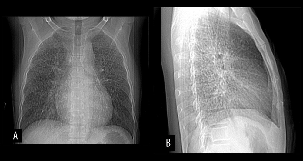 Plain radiograph of the chest in posteroanterior (A) and lateral (B) views showing multiple subcentimeter round nodules, predominantly in the middle to upper lung zones, characteristic of silicosis. None of the grossly evident nodules were more than 1 cm in diameter.