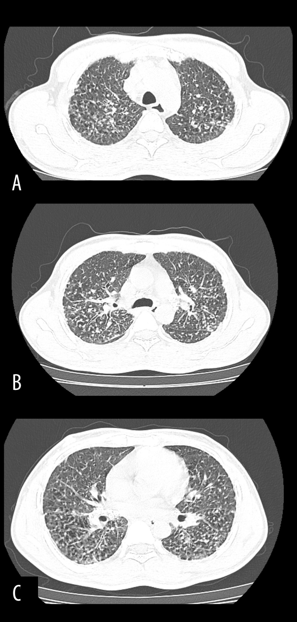 Axial CT (lung window) images at the level of the trachea (A), carina (B), and bilateral lower lobe bronchi (C) show multiple subcentimeter nodules, predominantly in the upper lobes and posterior portions of the lungs, characteristic of silicosis.